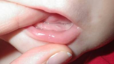 Signs and Symptoms of Teething in Babies