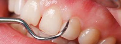 Swollen Gum Around a Tooth Causes and Prevention