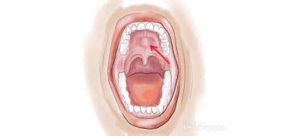 Swollen Roof of Mouth Causes and Treatment