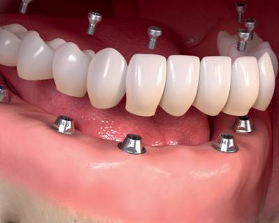 Teeth Implants Cost for Full Mouth