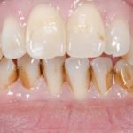 Tooth Discoloration (Stains on Teeth)