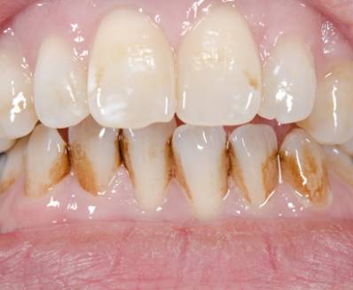 Tooth Discoloration (Stains on Teeth)
