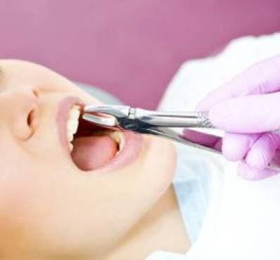 Tooth Extraction Procedure and Cost of Tooth Removal