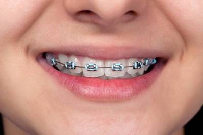 Underbite Braces for Teeth Correction Treatment Procedure and Cost
