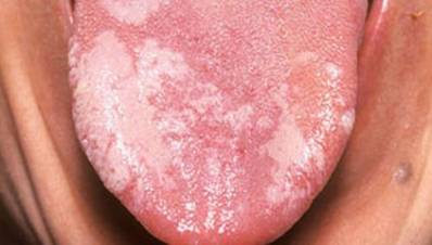 What Causes White Spots on Tongue