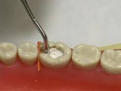 What Is A Dental Filling