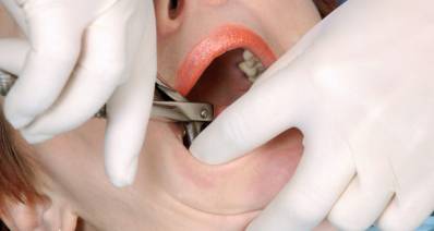 What Is a Tooth Extraction Tooth Removal Surgery Procedure