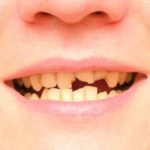 What to Do If You Have Chipped, Fractured or Broken Teeth