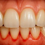 Close-up view of mild gum bleeding between teeth, showing early signs of gingivitis.