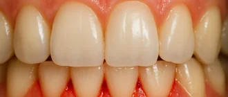 Close-up view of mild gum bleeding between teeth, showing early signs of gingivitis.