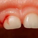 Close-up of baby gums with mild bleeding during teething, showing early signs of irritation and emerging primary teeth – pediatric oral health visual reference