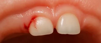 Close-up of baby gums with mild bleeding during teething, showing early signs of irritation and emerging primary teeth – pediatric oral health visual reference