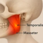 Anatomical illustration of the lower face showing jaw muscles with highlighted pain areas, including the masseter and temporalis, labeled with arrows.
