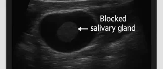 Ultrasound view used to diagnose a blocked salivary gland, illustrating how modern imaging helps detect and treat gland obstruction effectively.