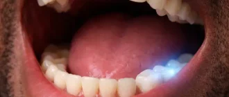 Close-up of an adult man’s open mouth showing mild blue glow on lower molars, illustrating tooth sensitivity and nerve response.
