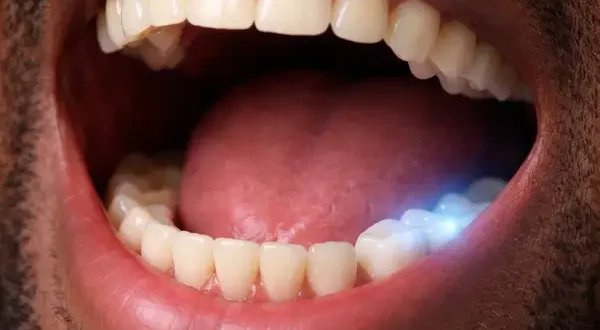 Close-up of an adult man’s open mouth showing mild blue glow on lower molars, illustrating tooth sensitivity and nerve response.