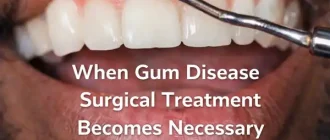 Close-up dental exam of a young bearded man showing inflamed gums during evaluation for gum disease surgery.