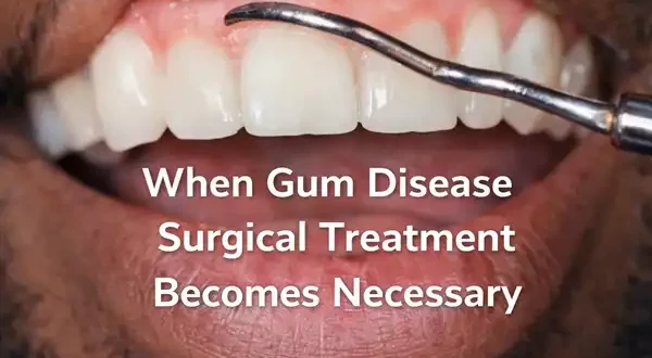 Close-up dental exam of a young bearded man showing inflamed gums during evaluation for gum disease surgery.