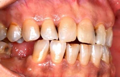 Bulimia Teeth Damage