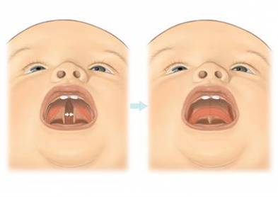 Cleft Palate Surgery Procedure