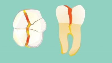 Cracked Tooth Syndrome