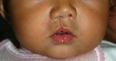 Dealing with Microform Cleft Lip