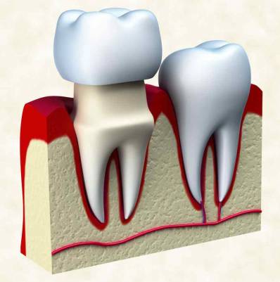 Dental Crowns Pain