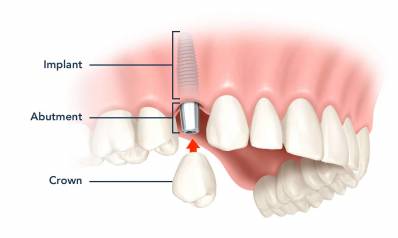 Dental Implants Front Teeth Is Tooth Implant Painful