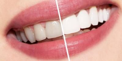 Disadvantages of Tooth Whitening