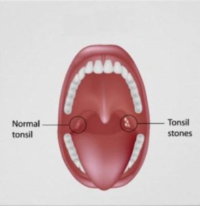 Do Tonsil Stones Cause Bad Breath? - Oral Health