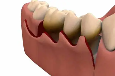 Gingival Flap Surgery