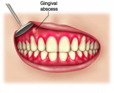 Gingival and Periodontal Abscesses and How to Treat Them