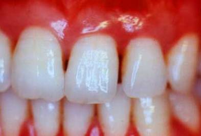pockets gum periodontal disease deep tooth reduce causes teeth bone remedies natural treating