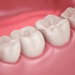 Gum Diseases, Periodontal Disease Stages