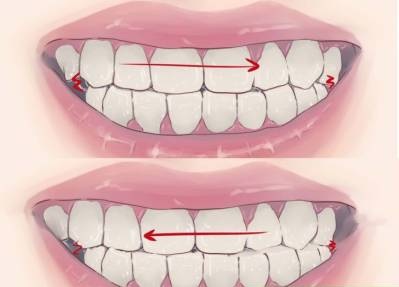 How to Stop Clenching Jaw