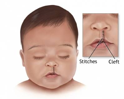 Is Cleft Lip Genetic