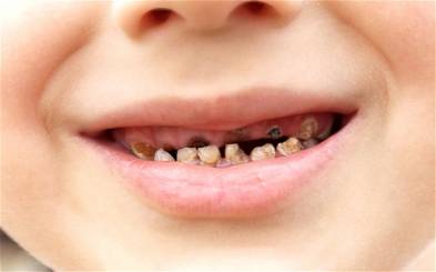 Kids Rotting Teeth What Is the Treatment for Toddlers Tooth Decay
