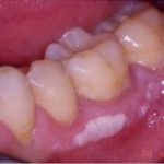 Leukoplakia (White Patch on Gums)