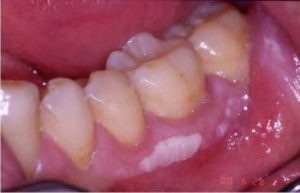 Leukoplakia White Patch On Gums Causes And Treatment   Leukoplakia White Patch On Gums 393x253 300x193 