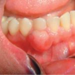 oral pyogenic granuloma