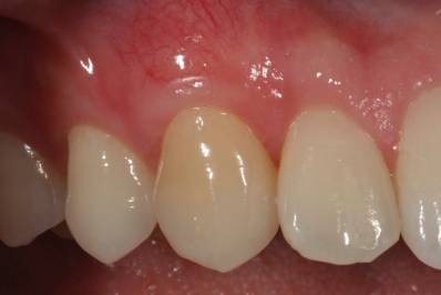 Receding Gums Graft