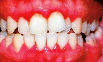 Signs of Gingivitis