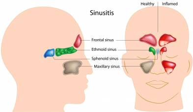 Sinusitis Vs. Bad Breath