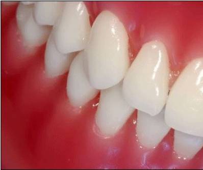 teeth translucent pain gums swollen
