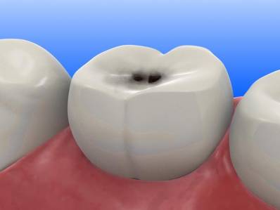 Teeth Cavities What Is Dental Caries