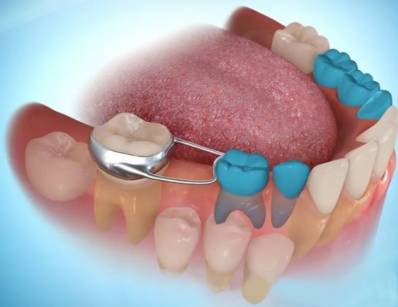 Tooth Space Maintainers What You Should to Know