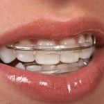 Usage of Retainers For Teeth