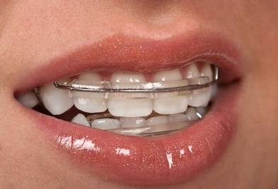 Usage of Retainers For Teeth