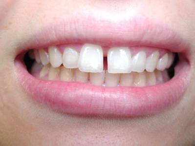 Using Teeth Bonding For Gaps Between Front Teeth