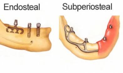 What Are Dentistry Implants